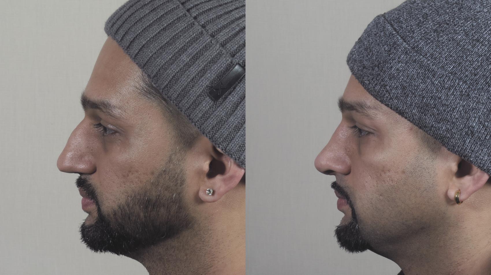 Rhinoplasty Case 1270 Before & After Left Side | Paramus, New Jersey | Parker Center for Plastic Surgery