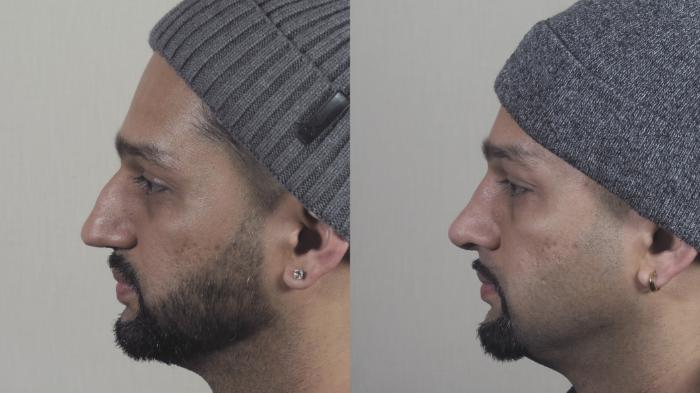 Rhinoplasty Case 1270 Before & After Left Side | Paramus, New Jersey | Parker Center for Plastic Surgery