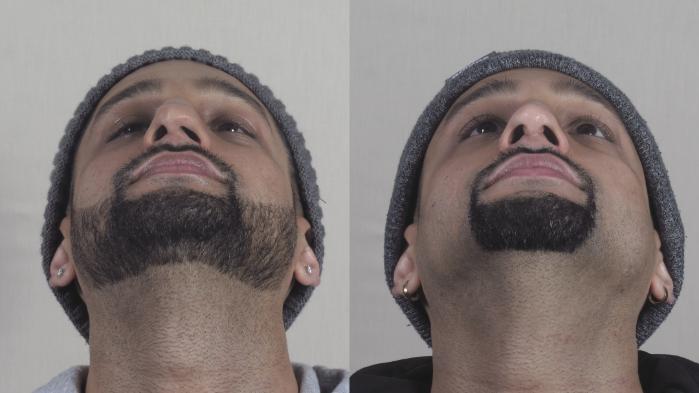 Rhinoplasty Case 1270 Before & After Worns View  | Paramus, New Jersey | Parker Center for Plastic Surgery