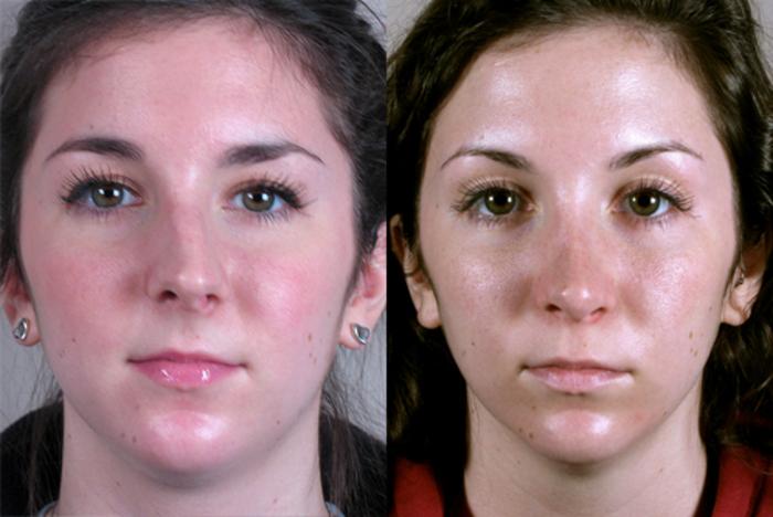 Rhinoplasty Case 128 Before & After View #1 | Paramus, New Jersey | Parker Center for Plastic Surgery
