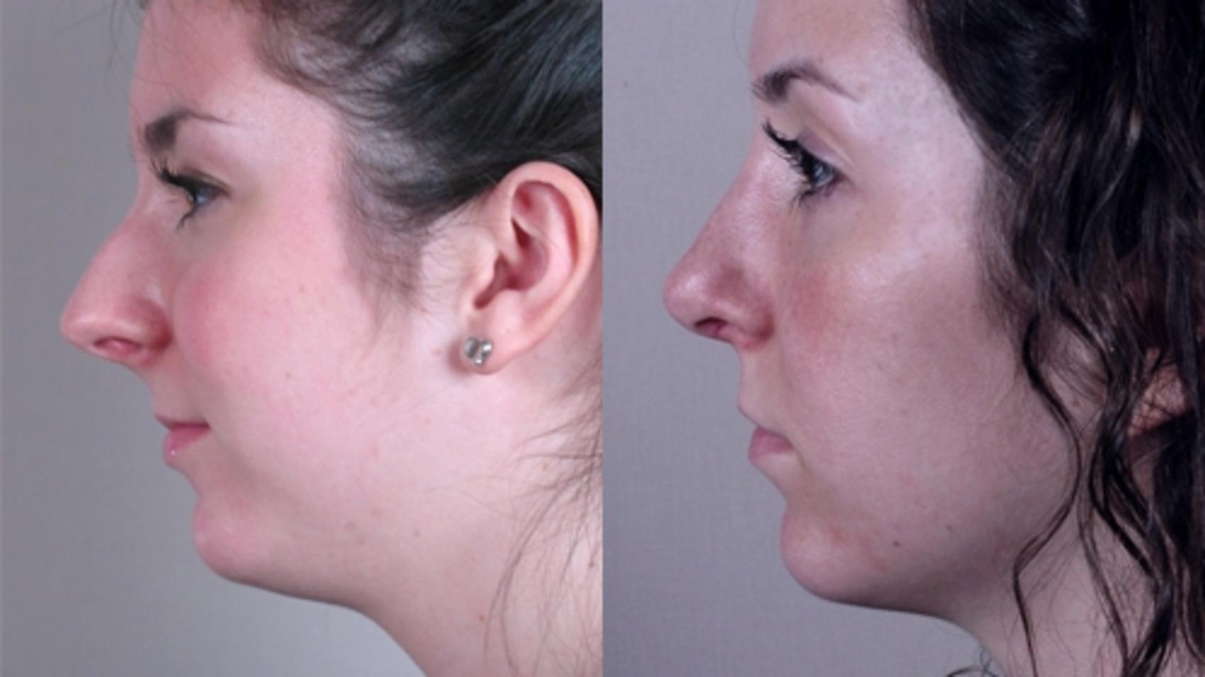 Rhinoplasty Case 128 Before & After View #2 | Paramus, New Jersey | Parker Center for Plastic Surgery