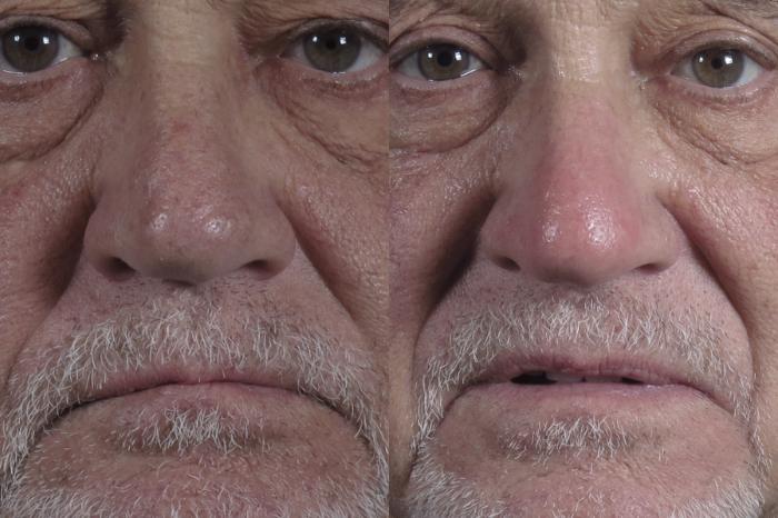 Rhinoplasty Case 1289 Before & After Front | Paramus, New Jersey | Parker Center for Plastic Surgery