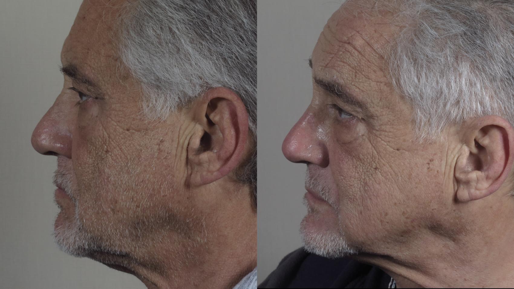 Rhinoplasty Case 1289 Before & After Left Side | Paramus, New Jersey | Parker Center for Plastic Surgery