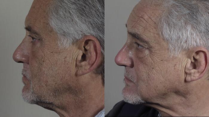 Rhinoplasty Case 1289 Before & After Left Side | Paramus, New Jersey | Parker Center for Plastic Surgery