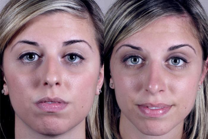 Rhinoplasty Case 129 Before & After View #1 | Paramus, New Jersey | Parker Center for Plastic Surgery