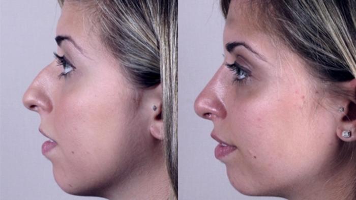 Rhinoplasty Case 129 Before & After View #2 | Paramus, New Jersey | Parker Center for Plastic Surgery