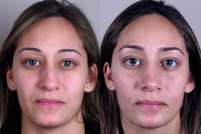 Rhinoplasty Case 130 Before & After View #1 | Paramus, New Jersey | Parker Center for Plastic Surgery
