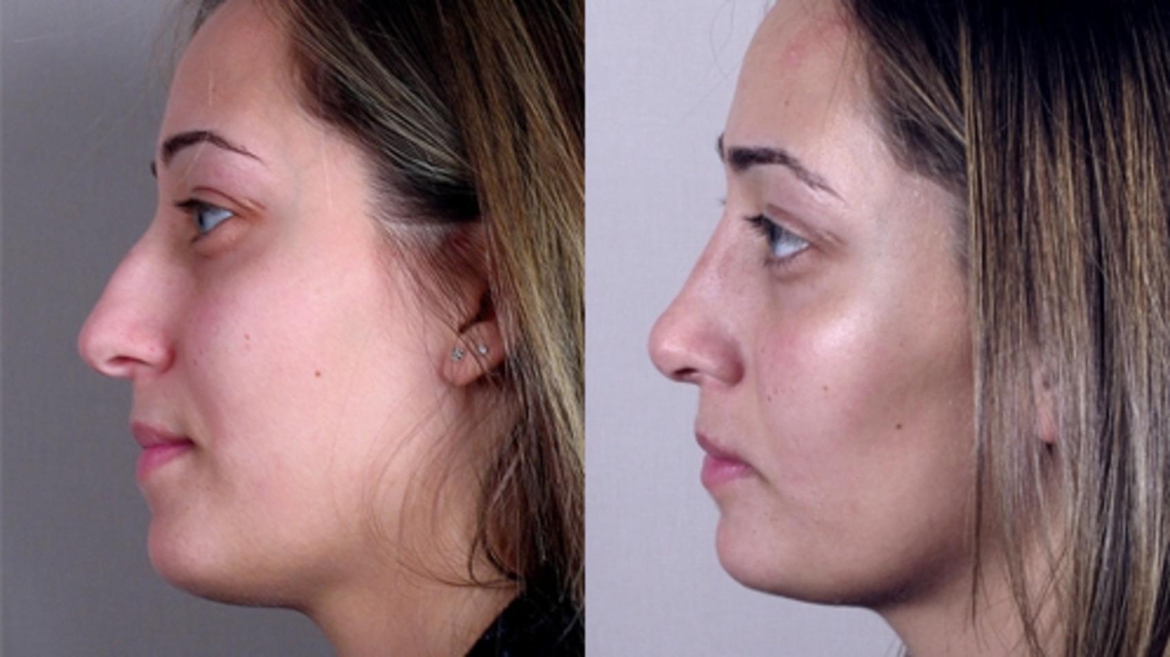 Rhinoplasty Case 130 Before & After View #2 | Paramus, New Jersey | Parker Center for Plastic Surgery