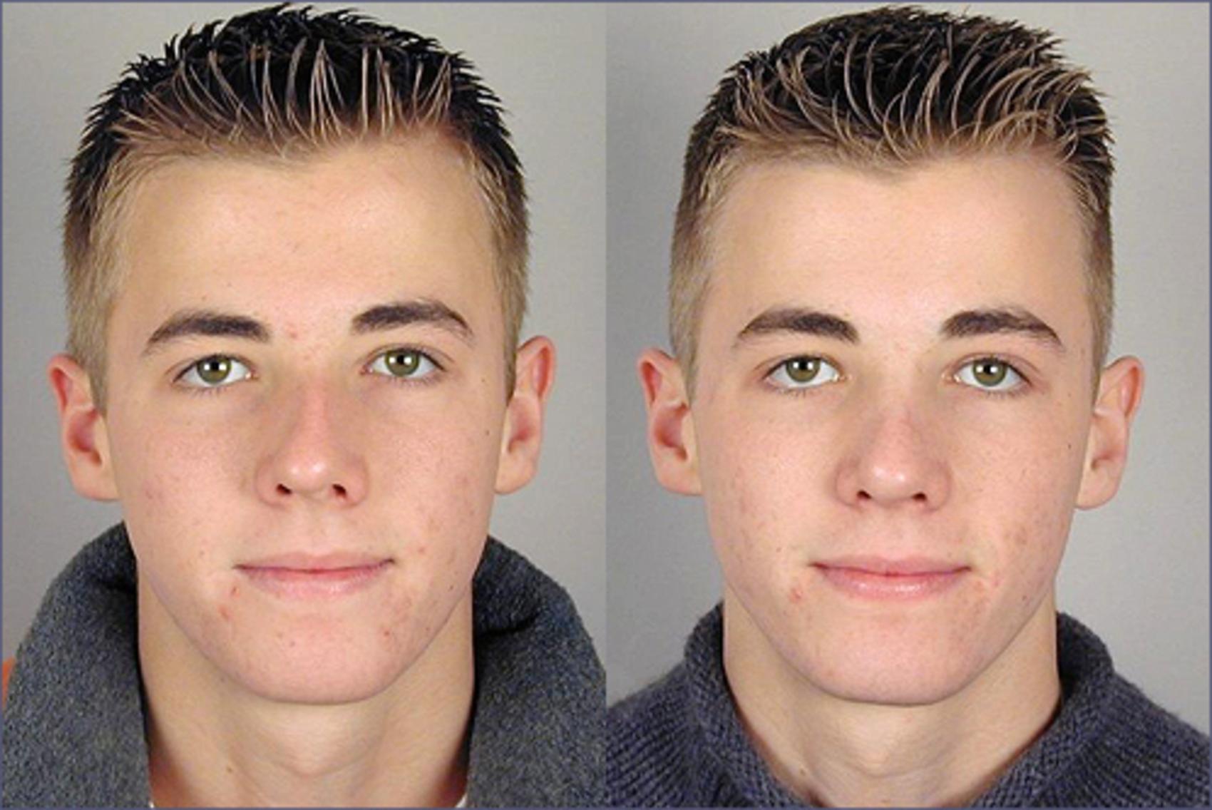 Rhinoplasty Case 131 Before & After View #1 | Paramus, New Jersey | Parker Center for Plastic Surgery