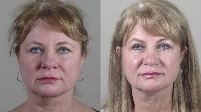 Rhinoplasty Case 1323 Before & After Front | Paramus, New Jersey | Parker Center for Plastic Surgery