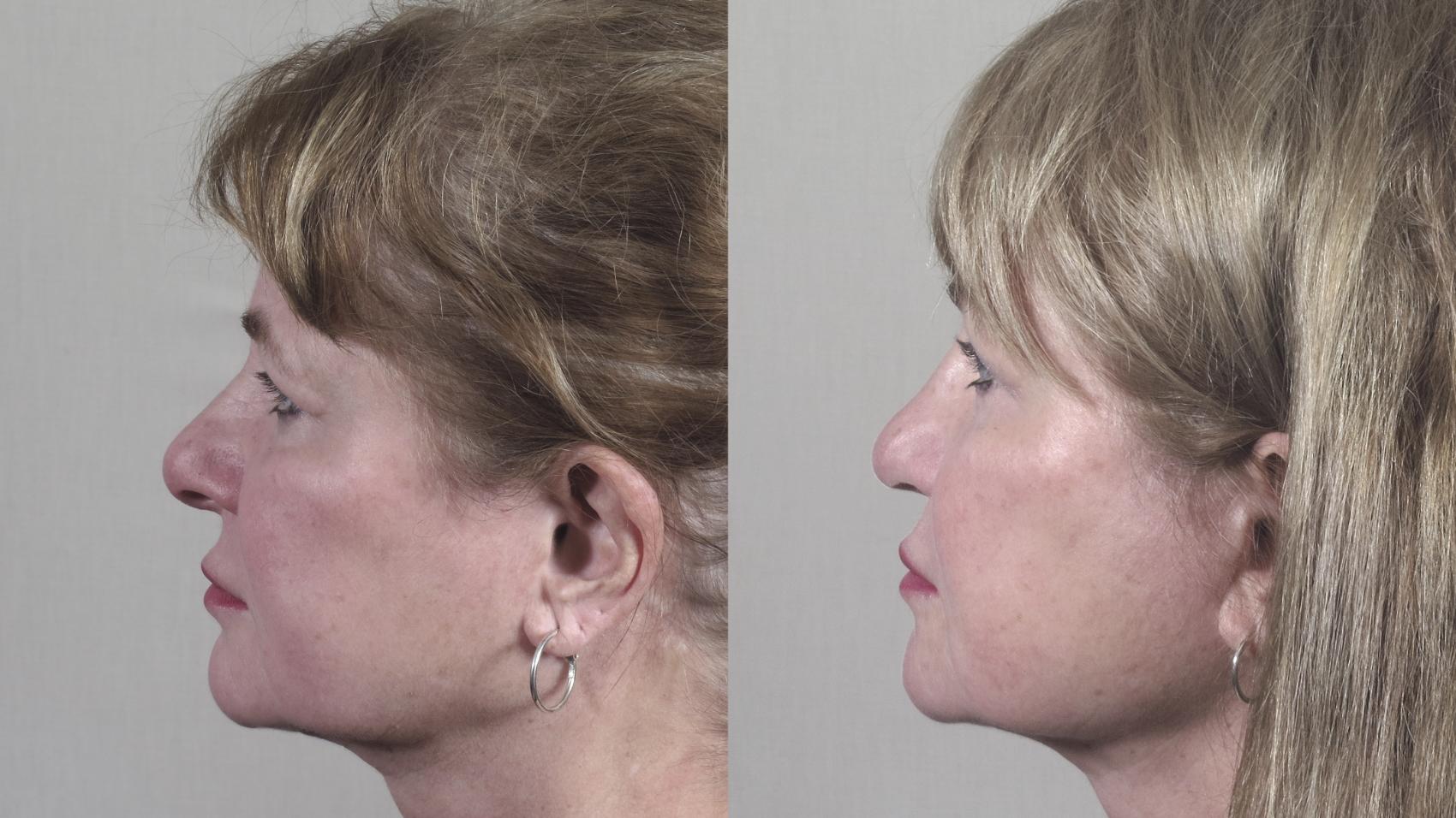 Rhinoplasty Case 1323 Before & After Left Side | Paramus, New Jersey | Parker Center for Plastic Surgery