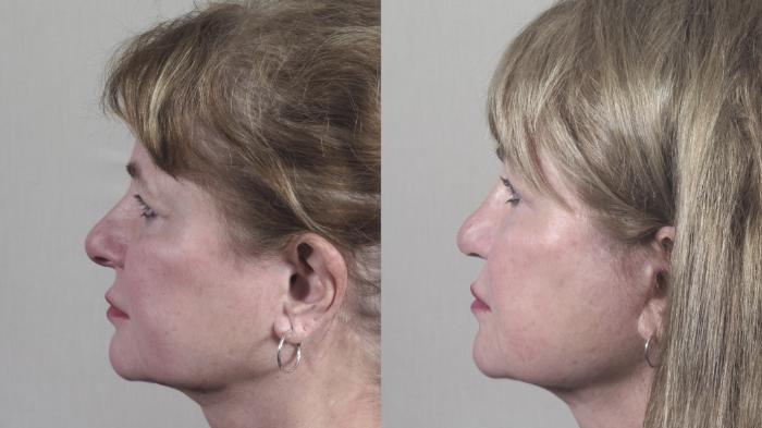 Rhinoplasty Case 1323 Before & After Left Side | Paramus, New Jersey | Parker Center for Plastic Surgery