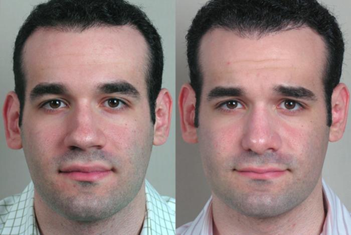 Rhinoplasty Case 133 Before & After View #1 | Paramus, New Jersey | Parker Center for Plastic Surgery