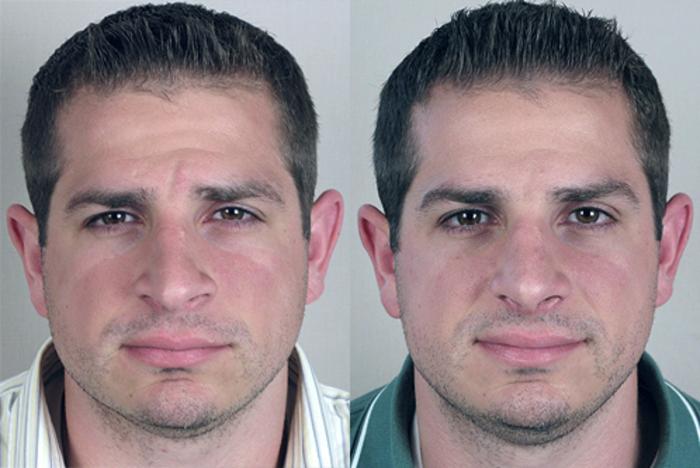 Rhinoplasty Case 134 Before & After View #1 | Paramus, New Jersey | Parker Center for Plastic Surgery