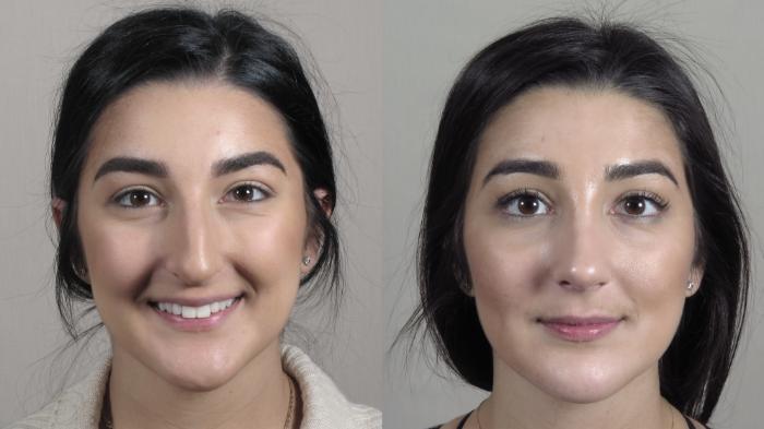 Rhinoplasty Case 1341 Before & After Front | Paramus, New Jersey | Parker Center for Plastic Surgery