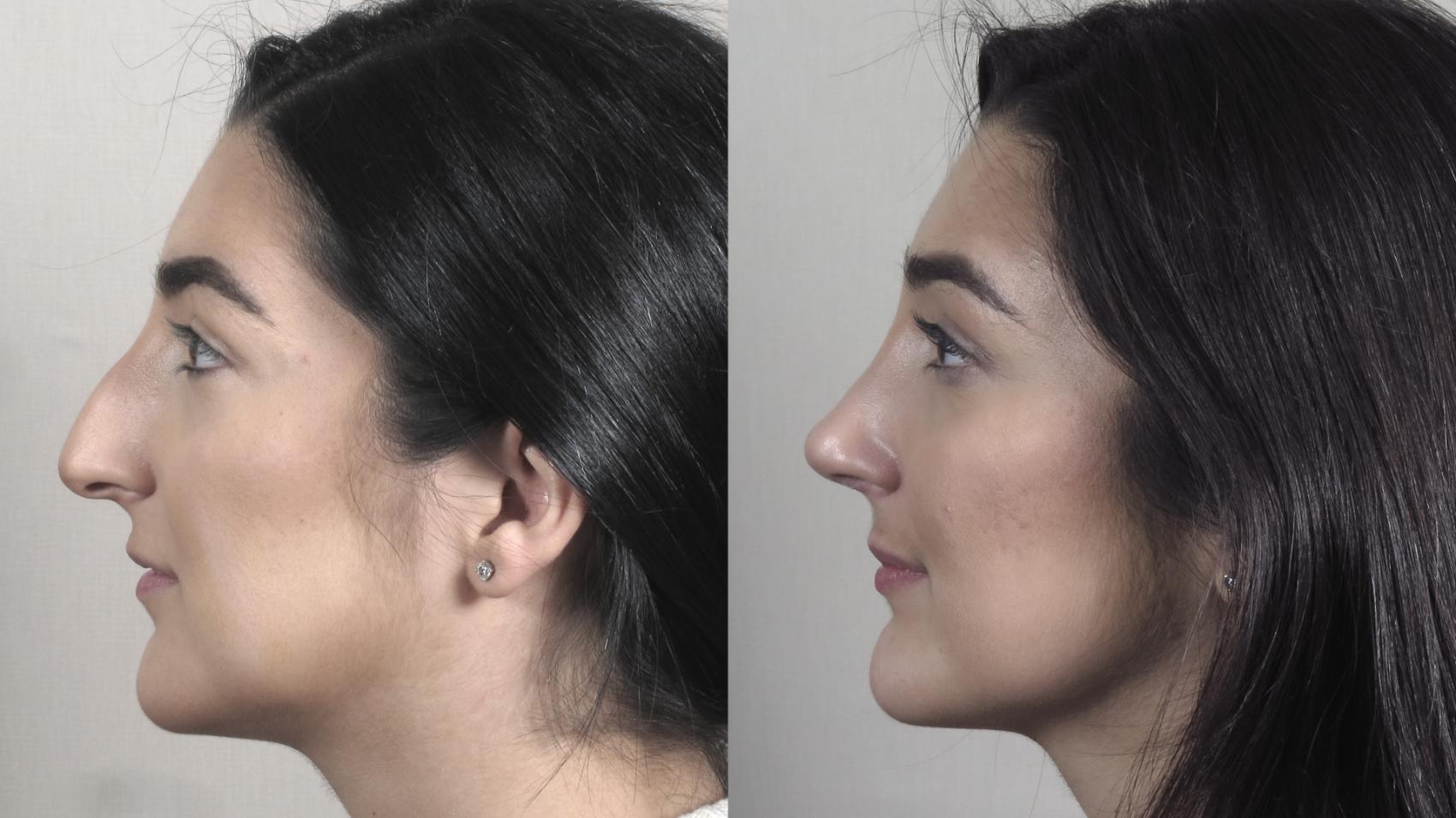 Rhinoplasty Case 1341 Before & After Left Side | Paramus, New Jersey | Parker Center for Plastic Surgery