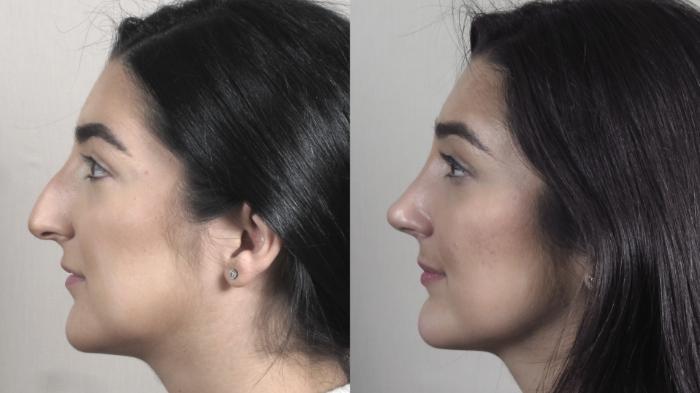 Rhinoplasty Case 1341 Before & After Left Side | Paramus, New Jersey | Parker Center for Plastic Surgery