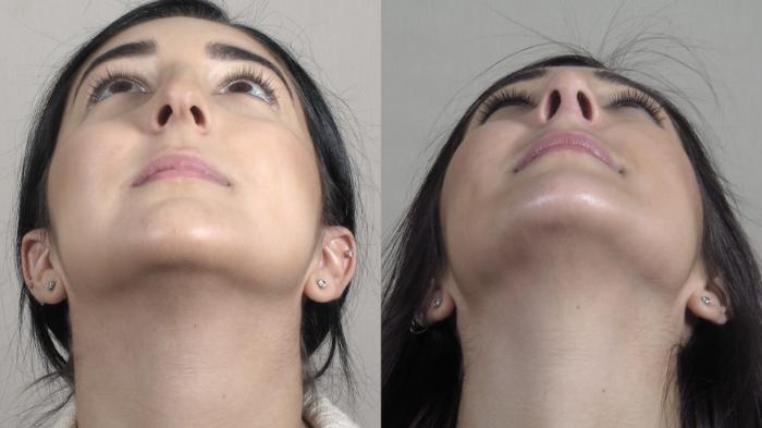 Rhinoplasty Case 1341 Before & After Worns View  | Paramus, New Jersey | Parker Center for Plastic Surgery
