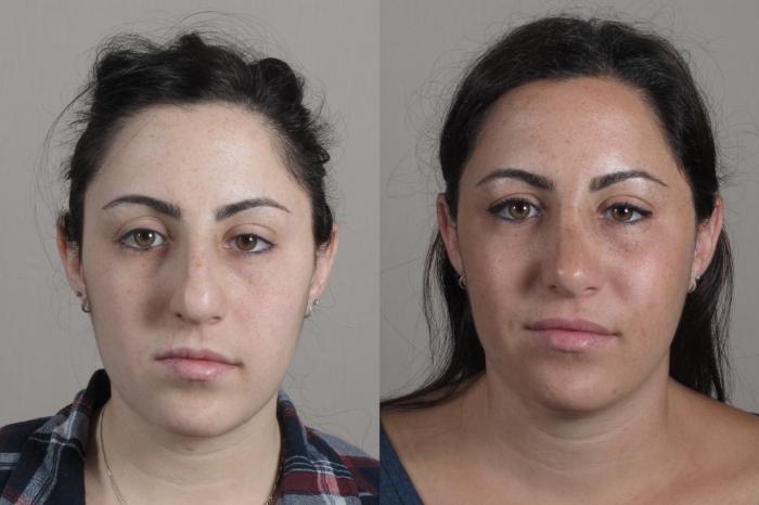 Rhinoplasty Case 1342 Before & After Front | Paramus, New Jersey | Parker Center for Plastic Surgery