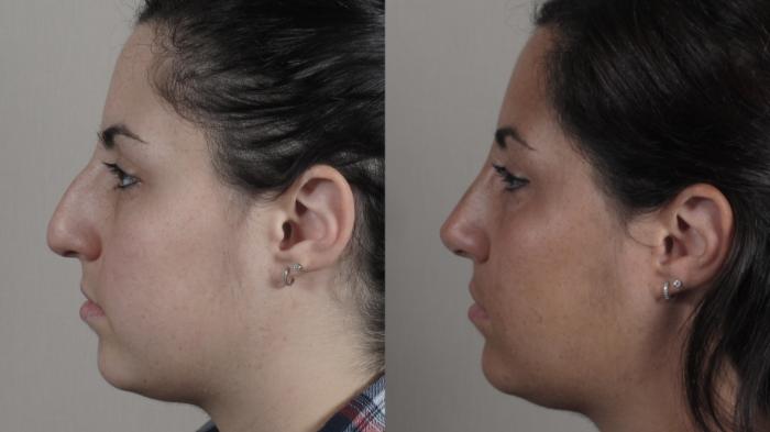 Rhinoplasty Case 1342 Before & After Left Side | Paramus, New Jersey | Parker Center for Plastic Surgery