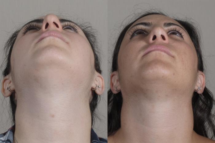 Rhinoplasty Case 1342 Before & After Worns View  | Paramus, New Jersey | Parker Center for Plastic Surgery