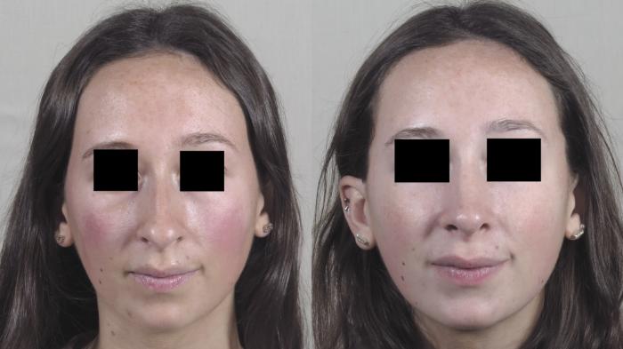 Rhinoplasty Case 1343 Before & After Front | Paramus, New Jersey | Parker Center for Plastic Surgery