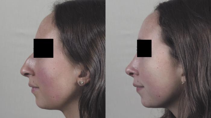 Rhinoplasty Case 1343 Before & After Left Side | Paramus, New Jersey | Parker Center for Plastic Surgery