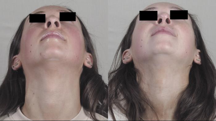 Rhinoplasty Case 1343 Before & After Worns View  | Paramus, New Jersey | Parker Center for Plastic Surgery