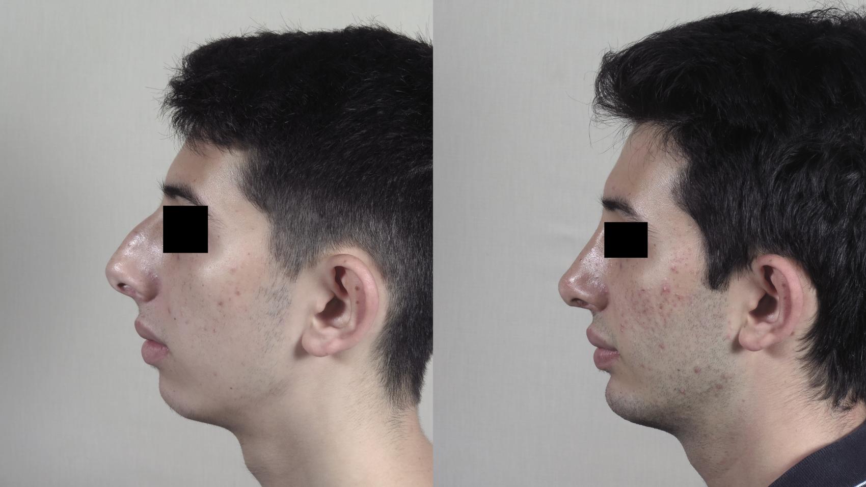 Rhinoplasty Case 1354 Before & After pre op  | Paramus, New Jersey | Parker Center for Plastic Surgery