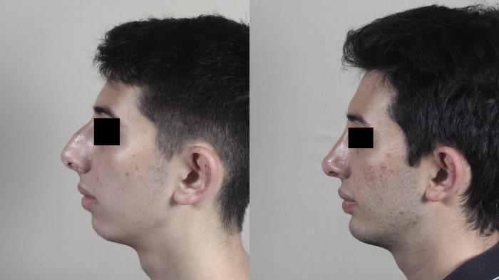 Rhinoplasty Case 1354 Before & After pre op  | Paramus, New Jersey | Parker Center for Plastic Surgery