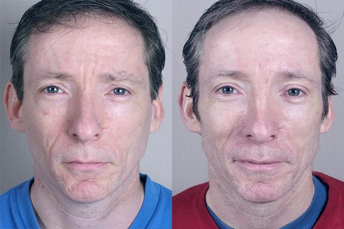 Rhinoplasty Case 136 Before & After View #1 | Paramus, New Jersey | Parker Center for Plastic Surgery