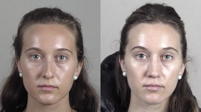 Rhinoplasty Case 1373 Before & After Front | Paramus, New Jersey | Parker Center for Plastic Surgery