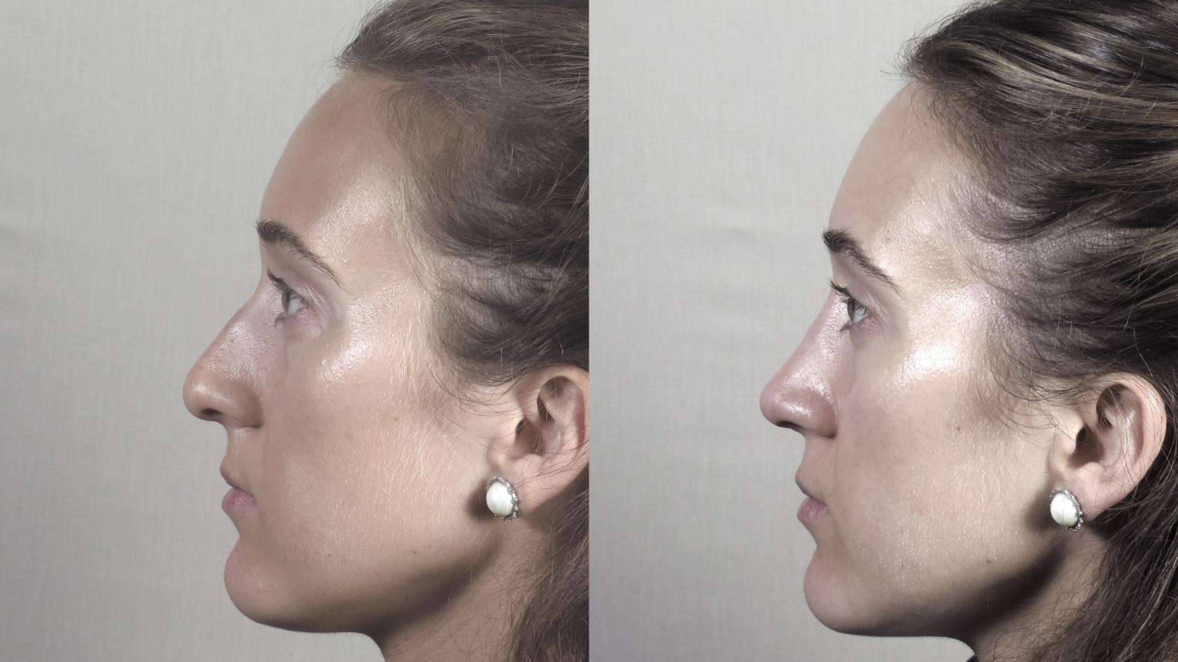 Rhinoplasty Case 1373 Before & After Left Side | Paramus, New Jersey | Parker Center for Plastic Surgery