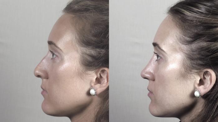 Rhinoplasty Case 1373 Before & After Left Side | Paramus, New Jersey | Parker Center for Plastic Surgery