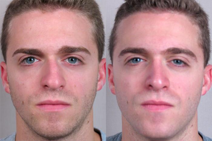 Rhinoplasty Case 138 Before & After View #1 | Paramus, New Jersey | Parker Center for Plastic Surgery