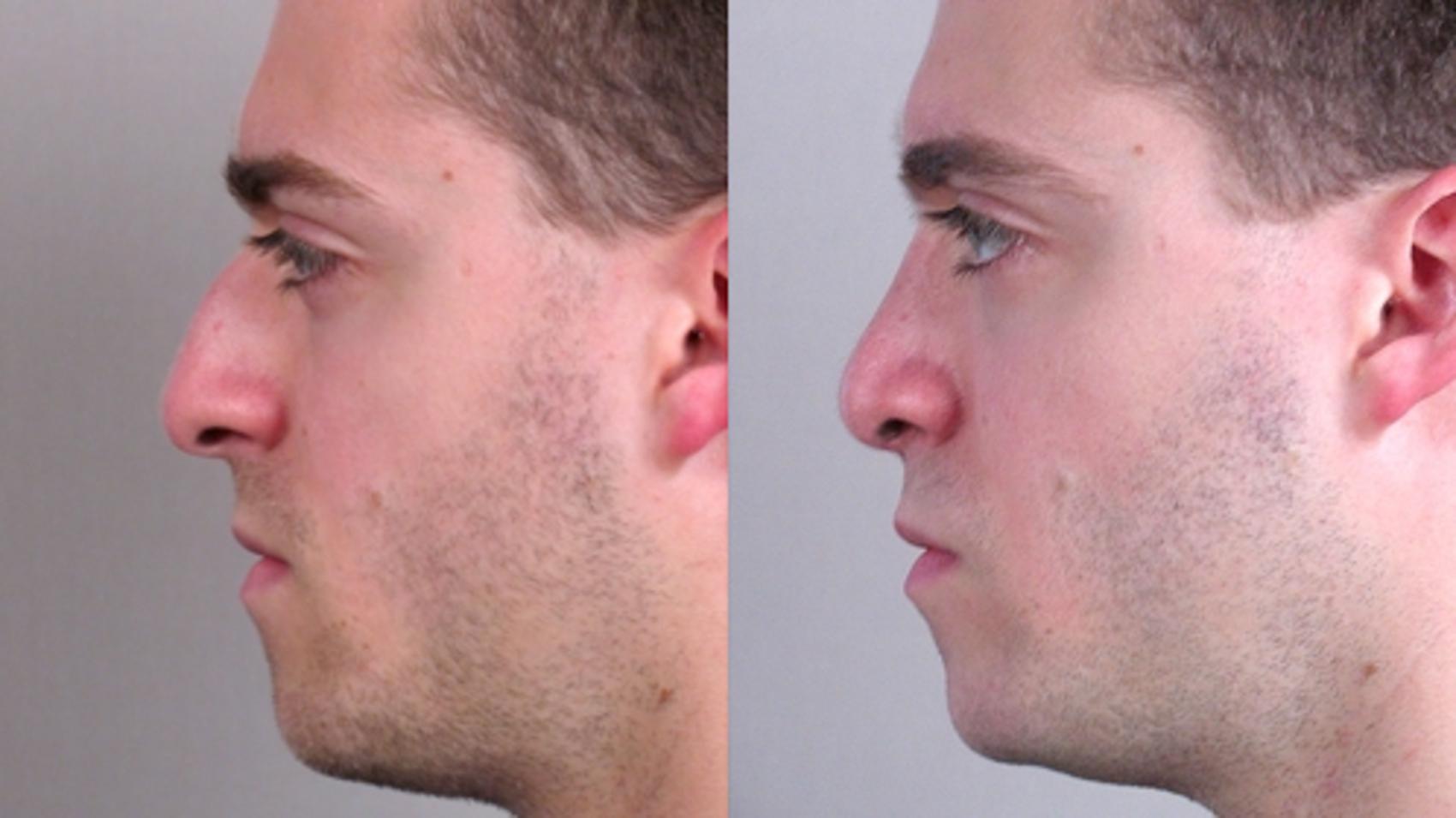 Rhinoplasty Case 138 Before & After View #2 | Paramus, New Jersey | Parker Center for Plastic Surgery
