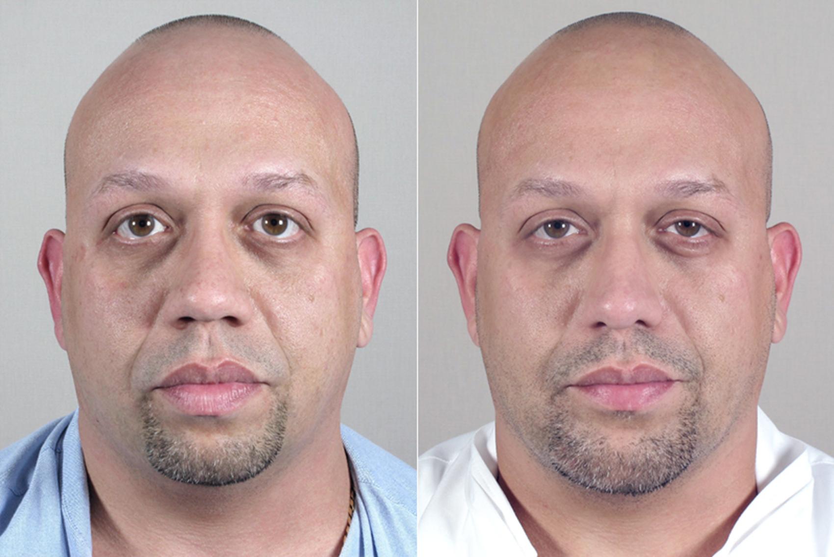Rhinoplasty Case 139 Before & After View #1 | Paramus, New Jersey | Parker Center for Plastic Surgery