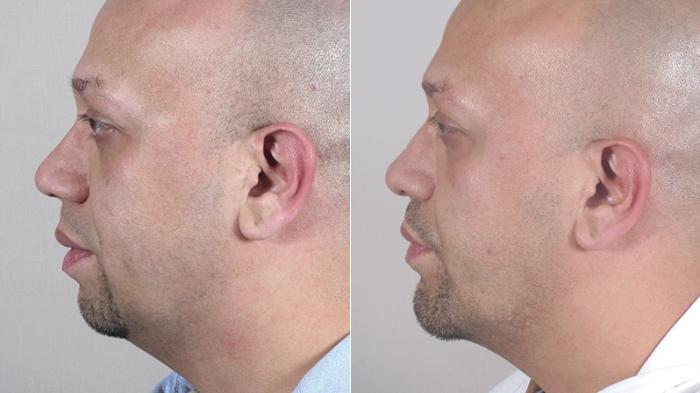 Chin Implant Case 139 Before & After View #2 | Paramus, New Jersey | Parker Center for Plastic Surgery