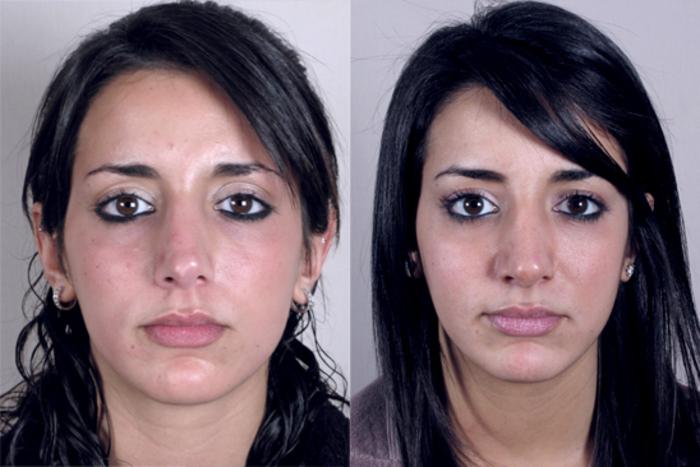 Rhinoplasty Case 140 Before & After View #1 | Paramus, New Jersey | Parker Center for Plastic Surgery