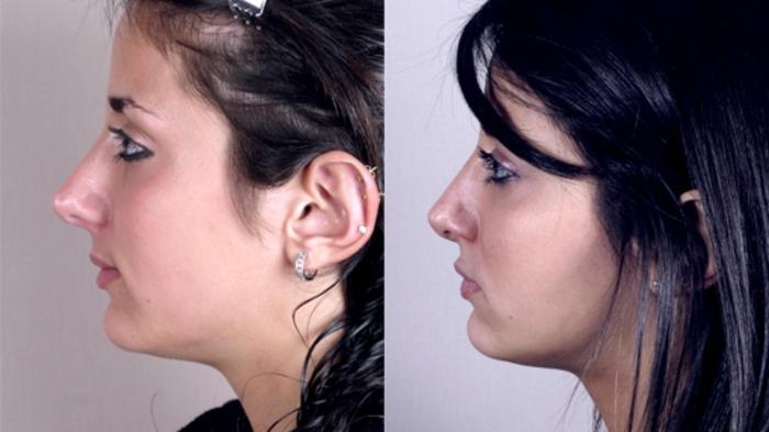 Rhinoplasty Case 140 Before & After View #2 | Paramus, New Jersey | Parker Center for Plastic Surgery