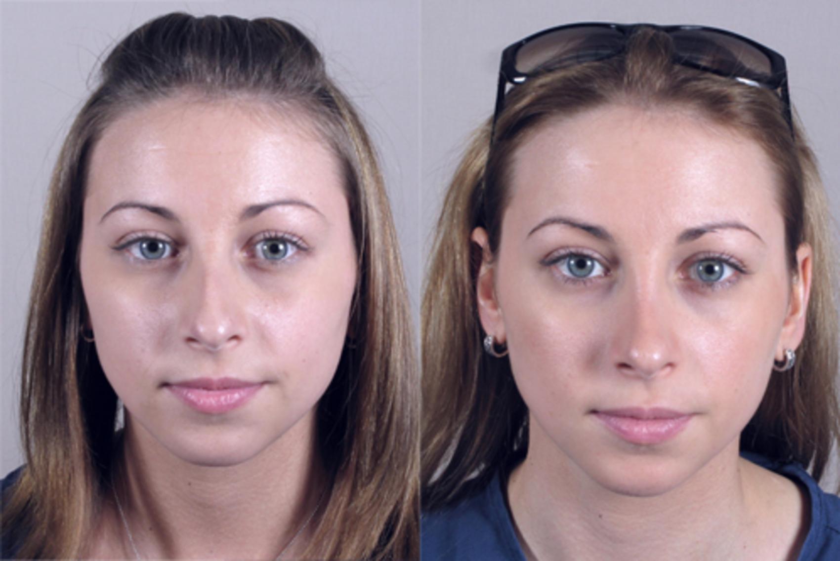Rhinoplasty Case 141 Before & After View #1 | Paramus, New Jersey | Parker Center for Plastic Surgery
