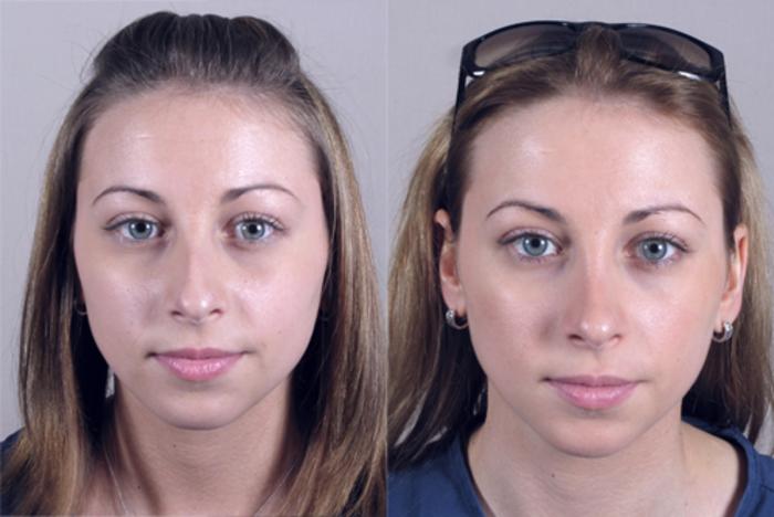 Rhinoplasty Case 141 Before & After View #1 | Paramus, New Jersey | Parker Center for Plastic Surgery