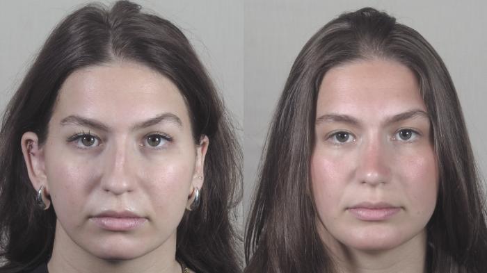Chin Implants Case 1416 Before & After Front | Paramus, New Jersey | Parker Center for Plastic Surgery