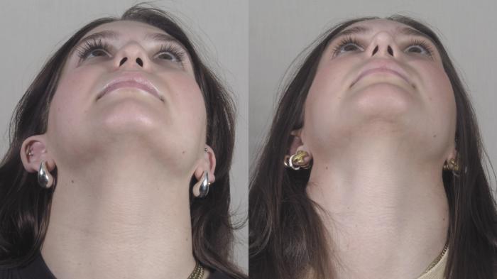 Chin Implants Case 1416 Before & After Looking up | Paramus, New Jersey | Parker Center for Plastic Surgery