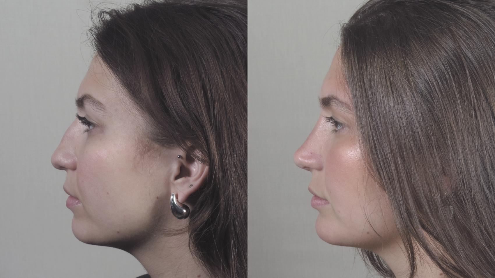 Rhinoplasty Case 1416 Before & After Side view | Paramus, New Jersey | Parker Center for Plastic Surgery