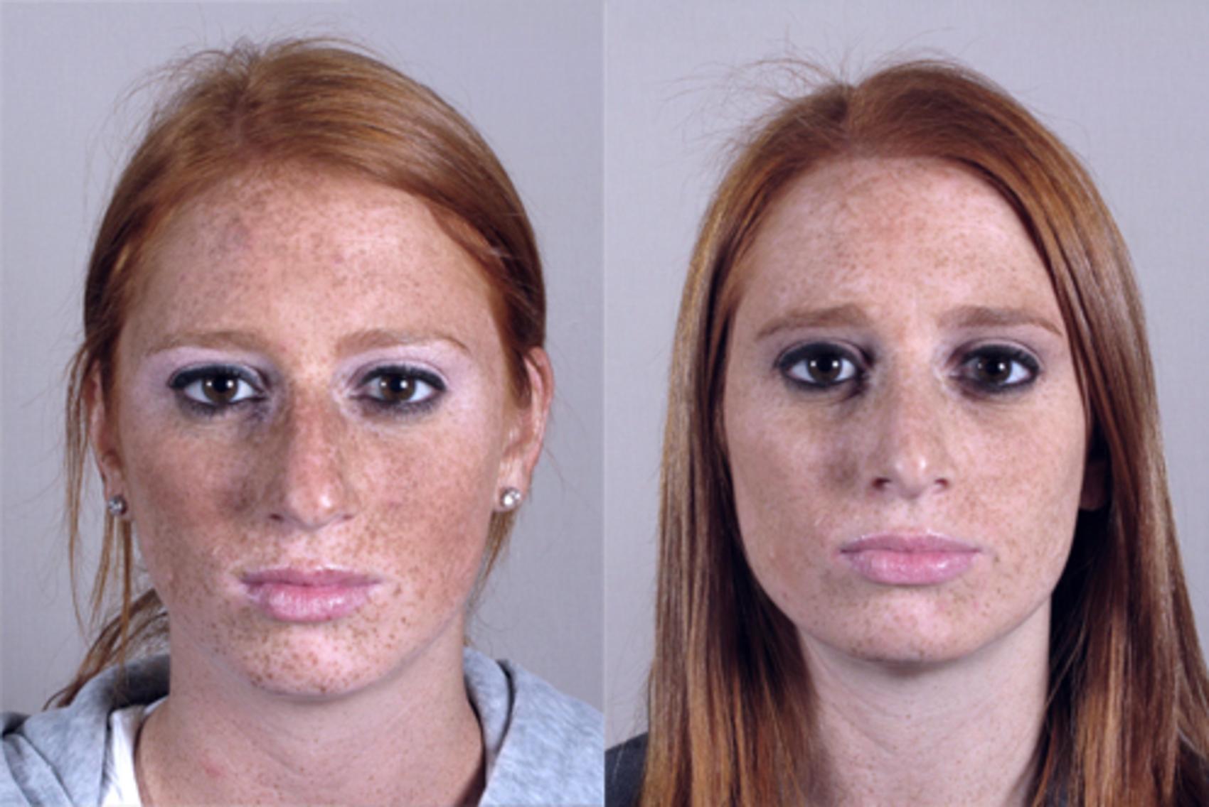 Rhinoplasty Case 142 Before & After View #1 | Paramus, New Jersey | Parker Center for Plastic Surgery