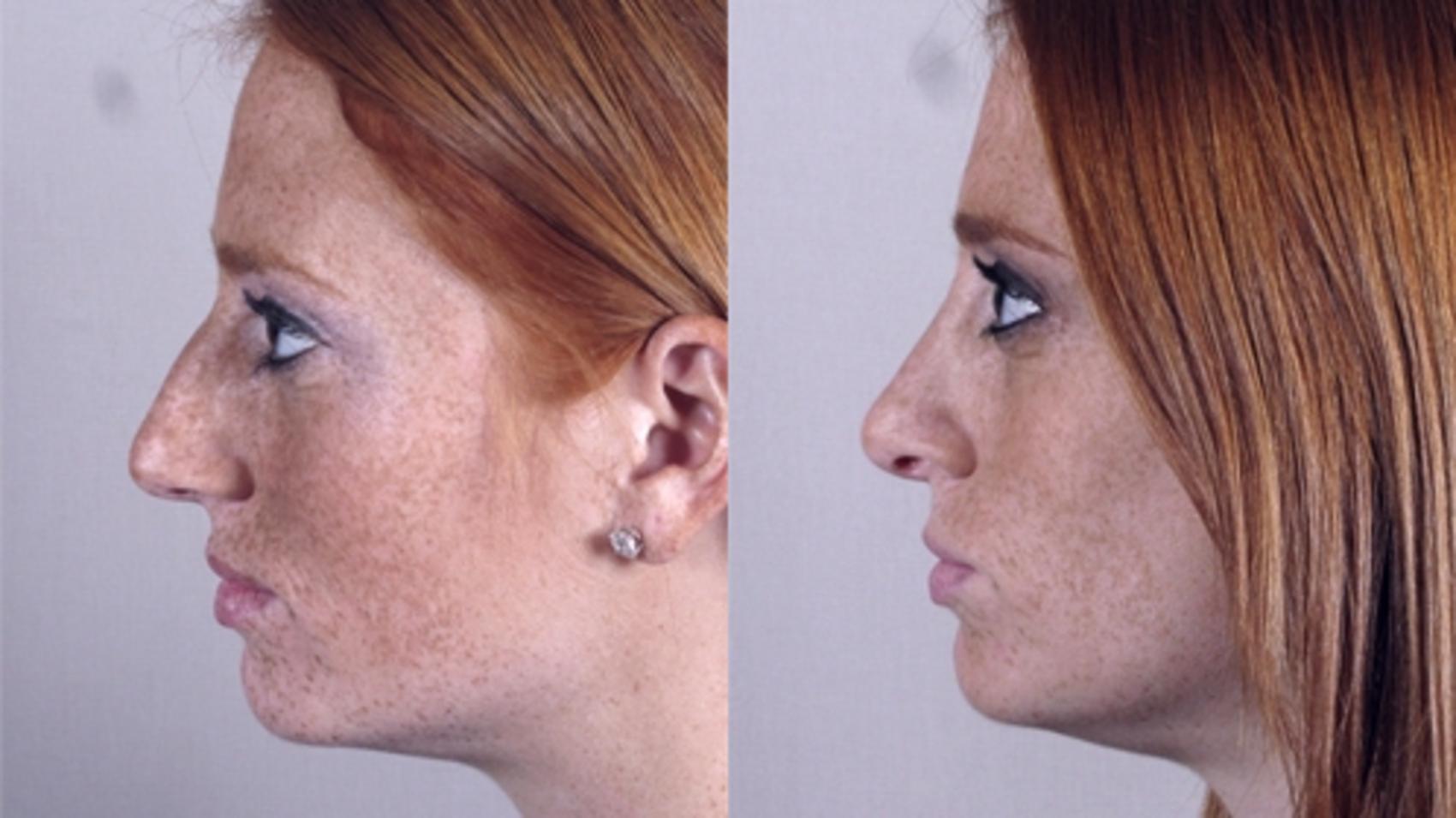 Rhinoplasty Case 142 Before & After View #2 | Paramus, New Jersey | Parker Center for Plastic Surgery