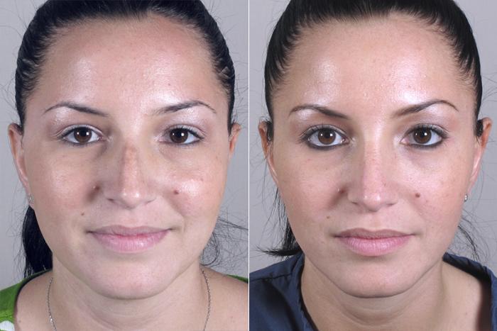 Rhinoplasty Case 143 Before & After View #1 | Paramus, New Jersey | Parker Center for Plastic Surgery