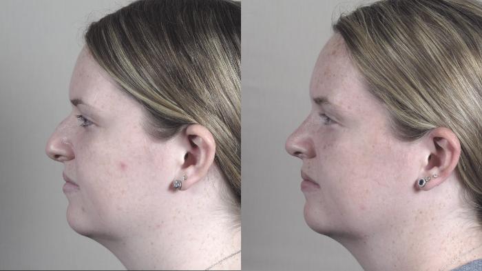Rhinoplasty Case 1445 Before & After Left Side | Paramus, New Jersey | Parker Center for Plastic Surgery