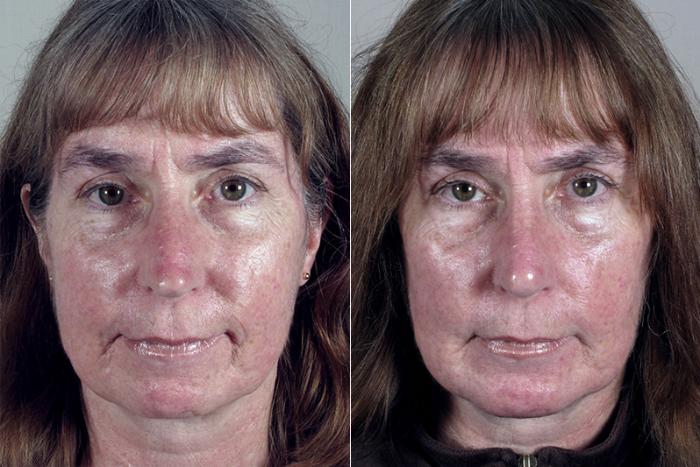 Rhinoplasty Case 145 Before & After View #1 | Paramus, New Jersey | Parker Center for Plastic Surgery